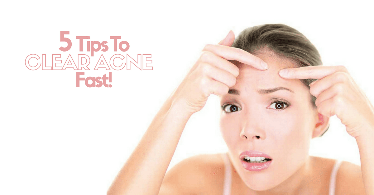 5-tips-to-clear-acne-fast